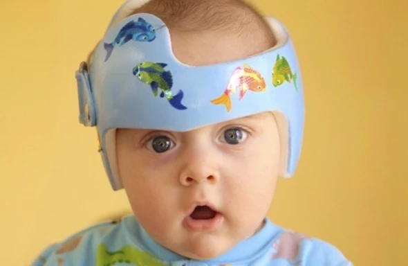 Κρανίο θεραπείας πλαγιοκεφαλίας